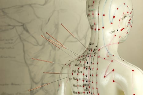 There are many similarities between IMS and Acupuncture