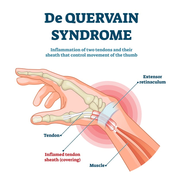 De Quervain Syndrome