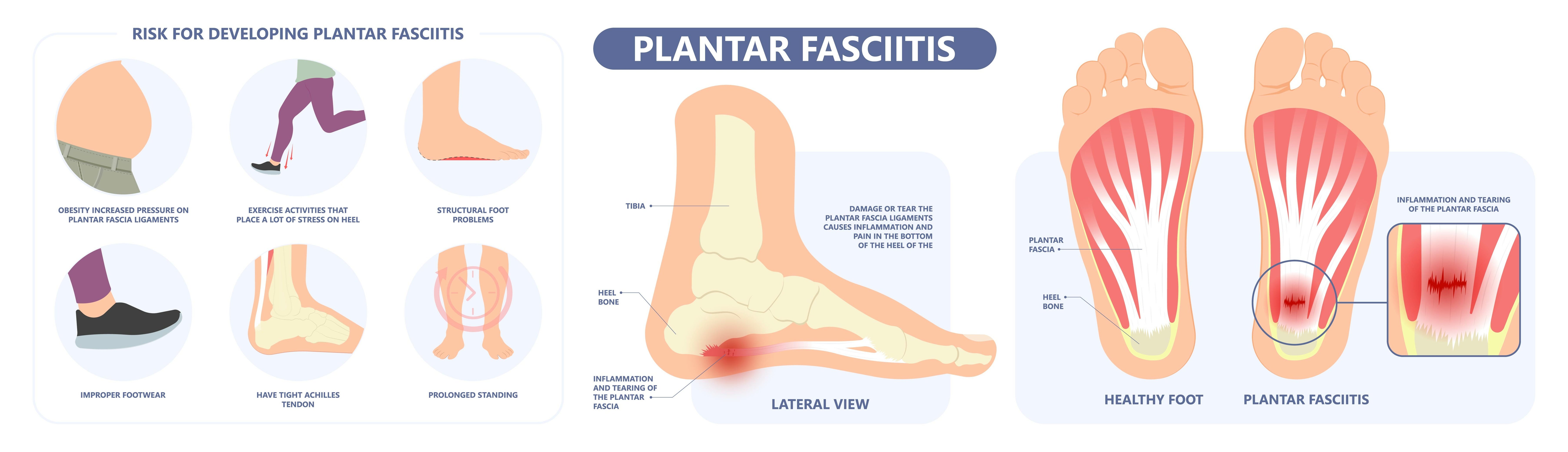 Plantar fasciitis — treatment, symptoms and causes | healthdirect