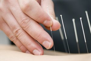 similarities between Acupuncture and Traditional Chinese Medicine