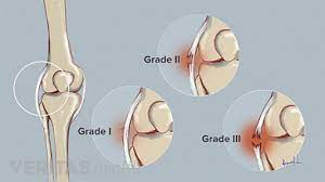 What Is a Knee Sprain?