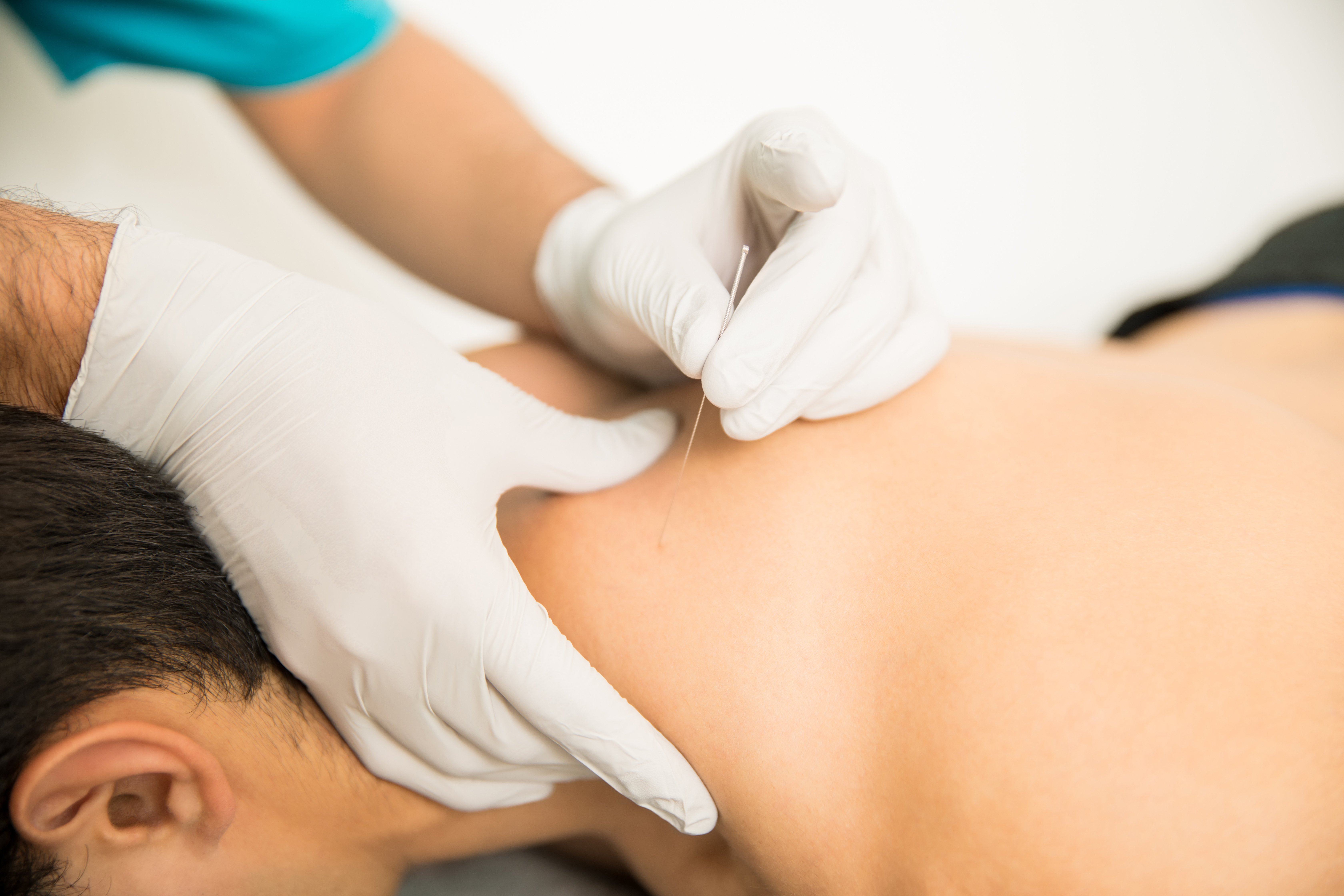 Dry Needling in Physiotherapy for Sport Injuries